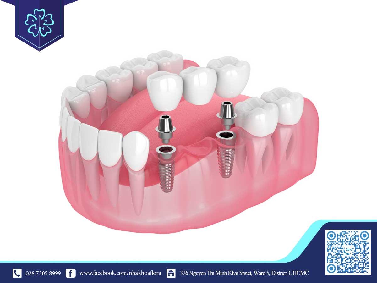 Tại sao không nên trì hoãn trồng răng implant?