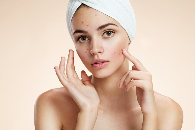 Mẹo skincare giúp trị thâm mụn hiệu quả?