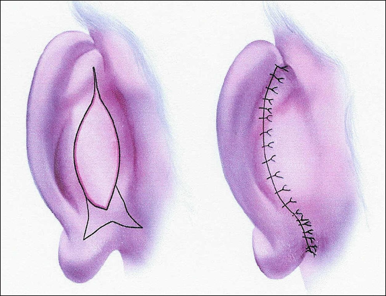 otoplasty-ear-setback-indianapolis-dr-barry-eppley3