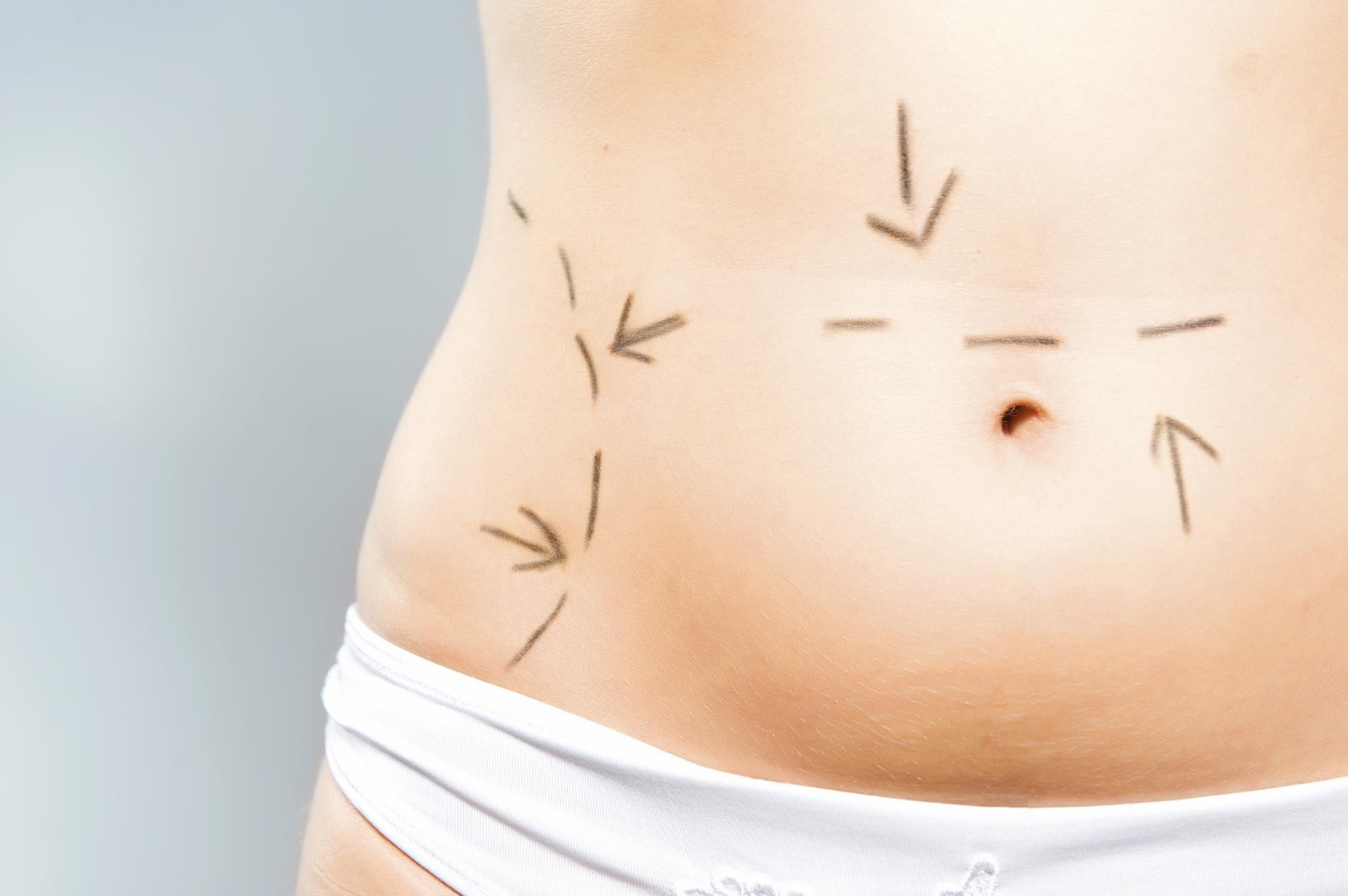 Woman-with-Drawings-on-Stomach.-Tummy-Tuck