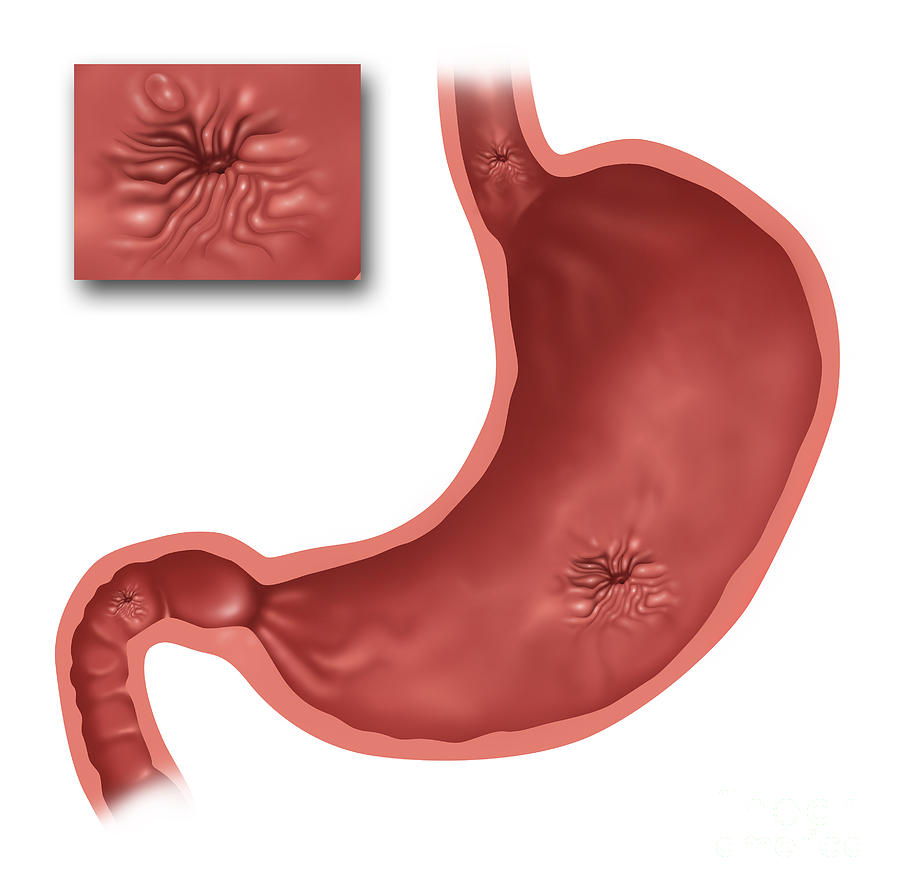 1-stomach-ulcers-illustration-gwen-shockey