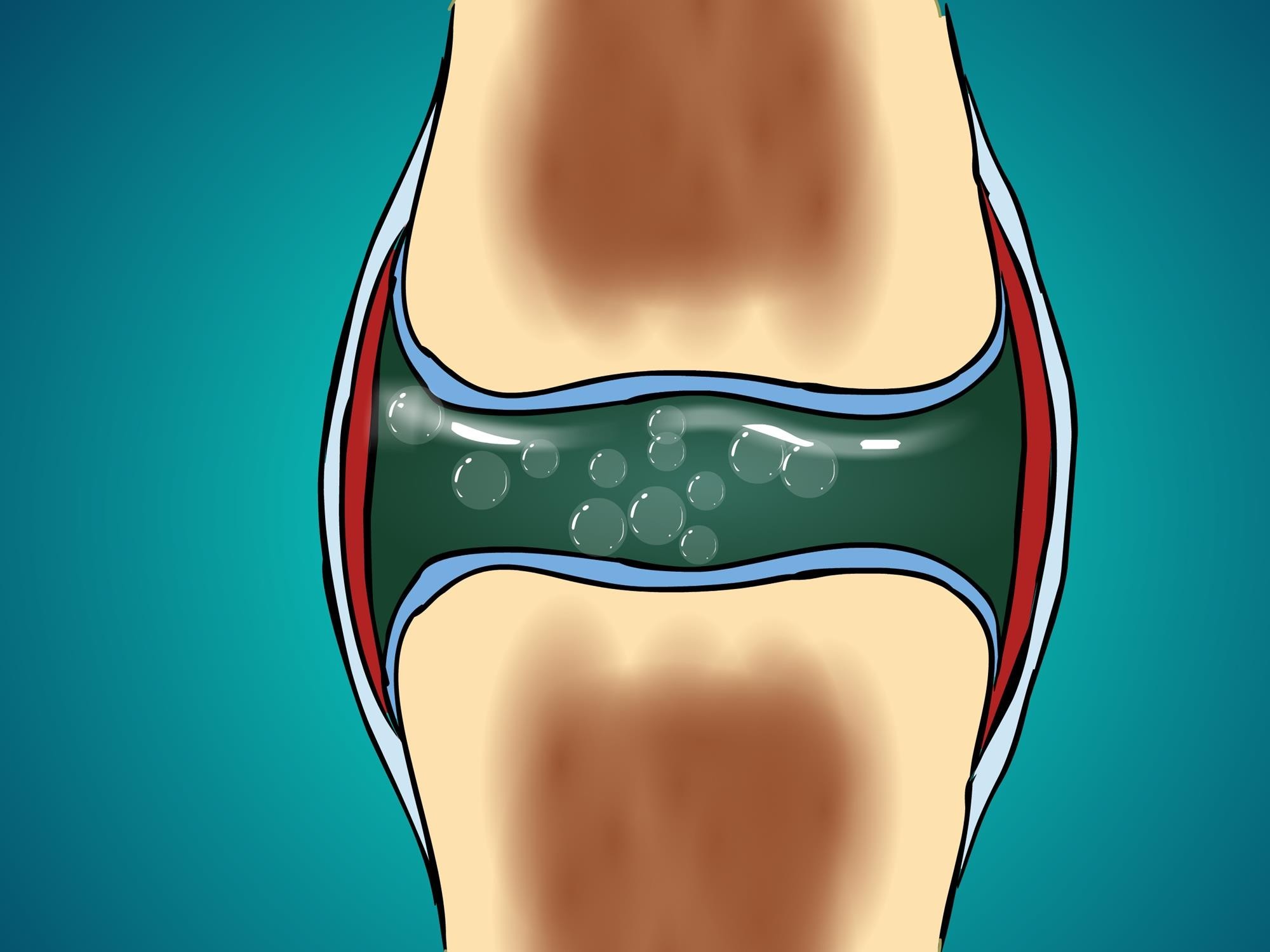 Synovial-fluid-cavitation