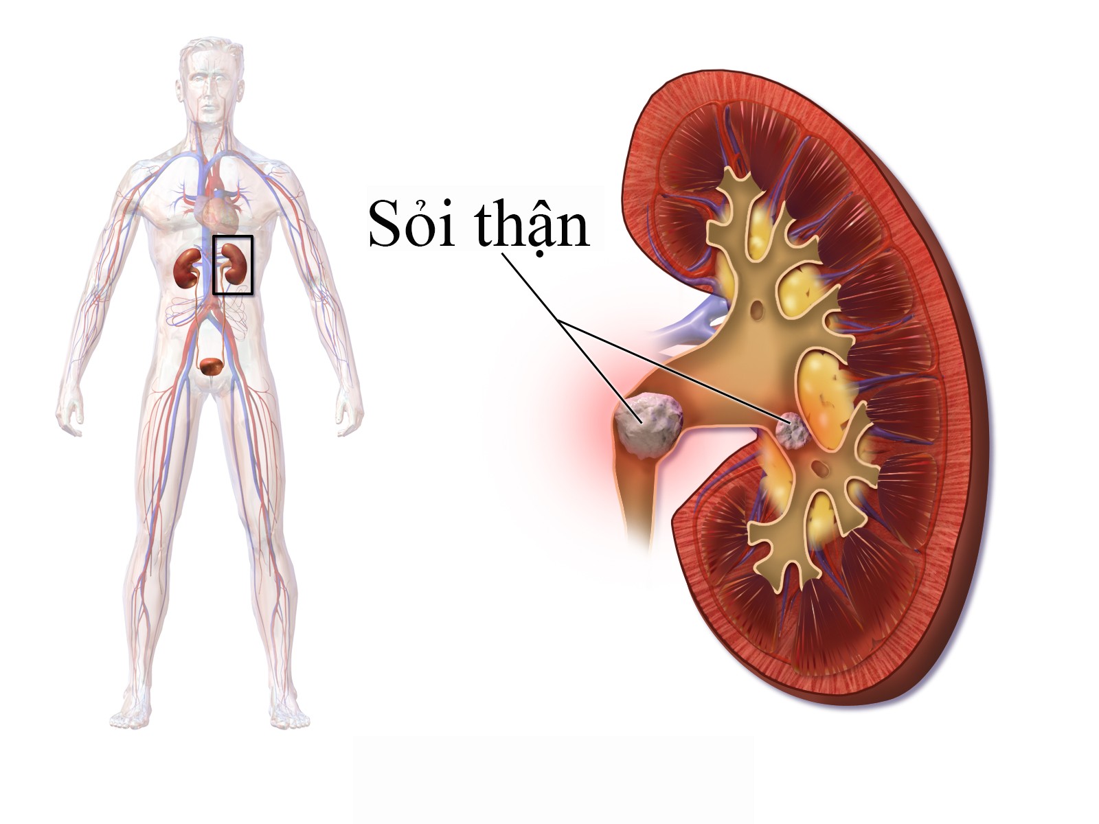 Blausen 0595 KidneyStones