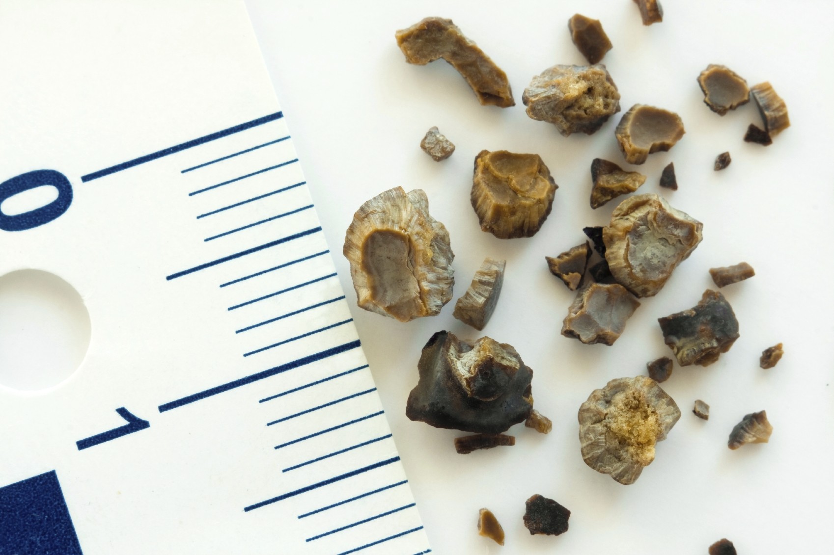 kidney-stone-image