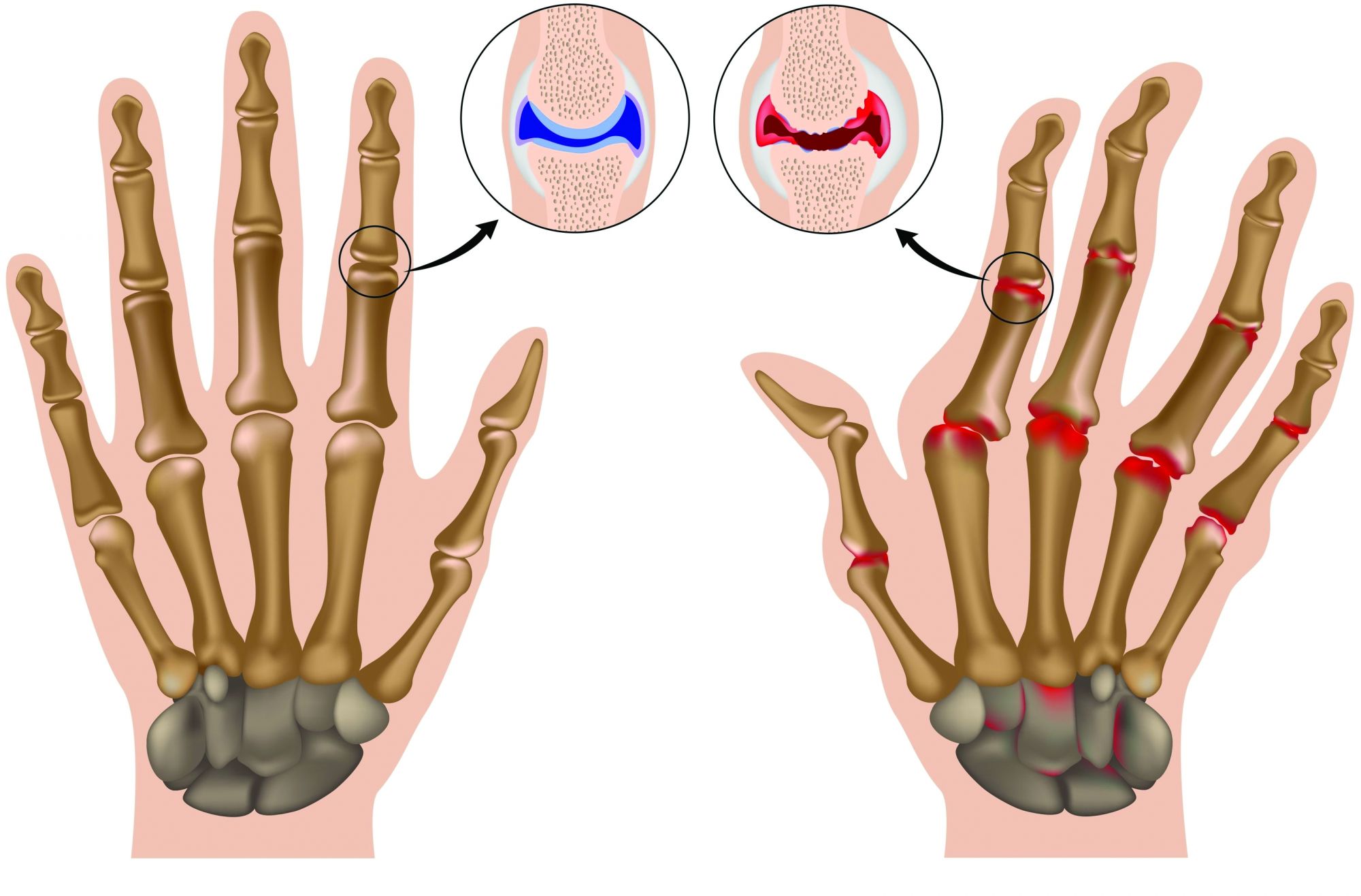 osterarthritis