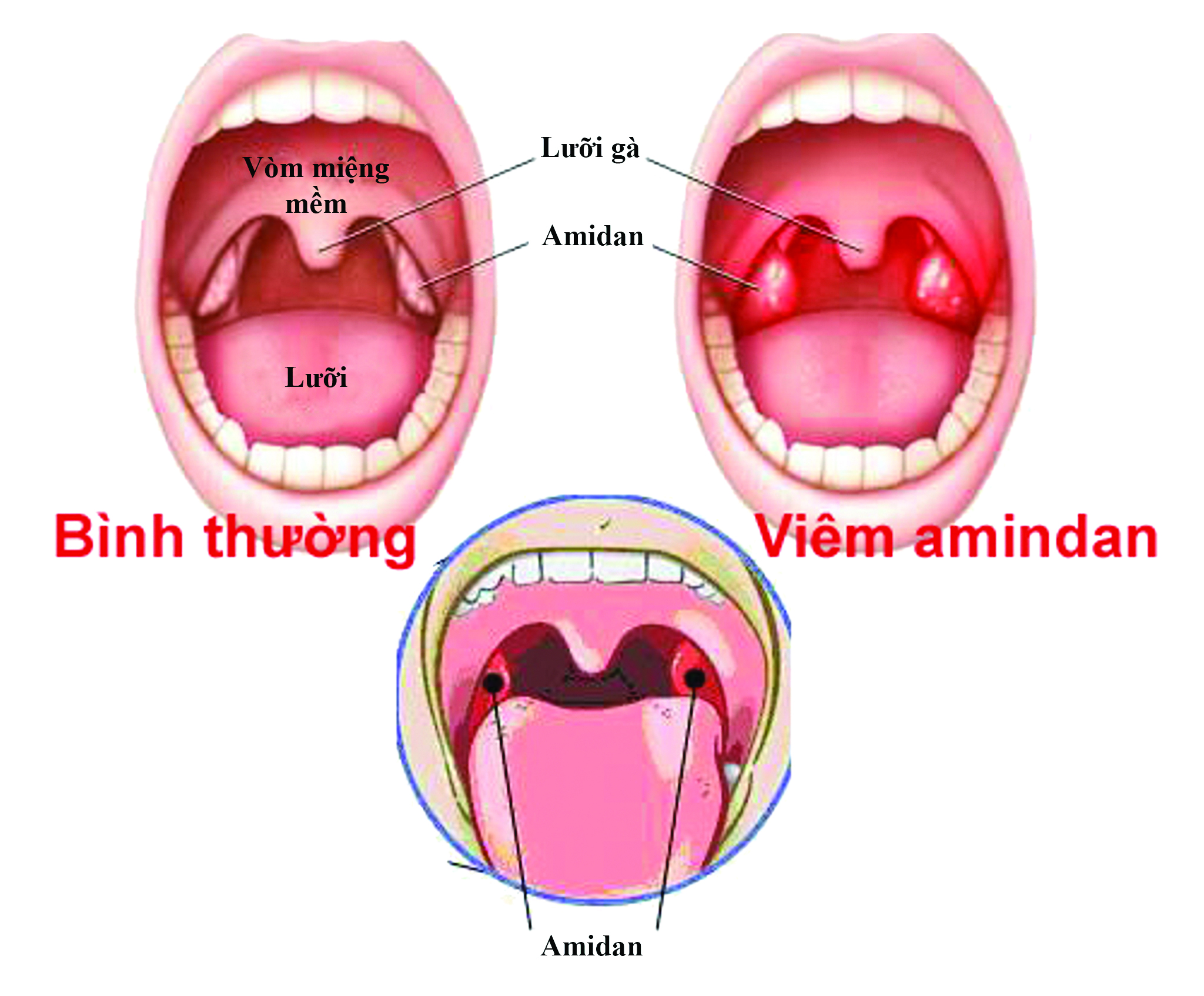 Hình ảnh viêm amidan từng loại - Nhà thuốc FPT Long Châu