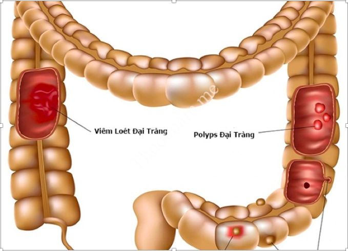 Thiếu niên 14 tuổi cần chú ý gì để tránh mắc phải ung thư cổ tử cung?