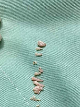 Quảng Bình: Bệnh nhân có khối u chứa hàng chục chiếc răng