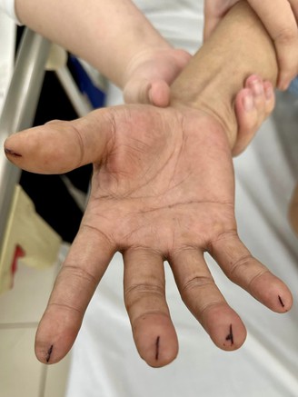 Vợ dùng dao lam cắt 5 đầu ngón tay chồng để cấp cứu đột quỵ