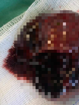 Quảng Bình: Thanh niên 18 tuổi mất một bên tinh hoàn vì nhập viện muộn