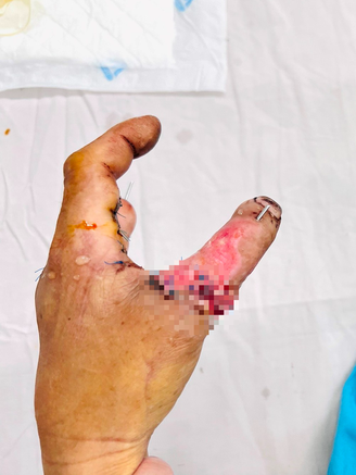Nối ngón tay giữa vào ngón cái bị mất do tai nạn