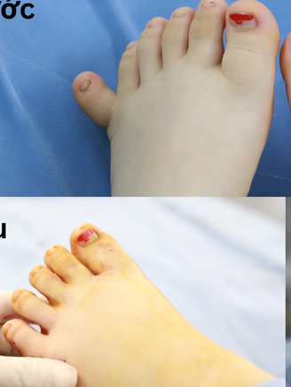 Hiếm gặp: Bệnh nhi thừa ngón, có đến 12 ngón tay, 12 ngón chân