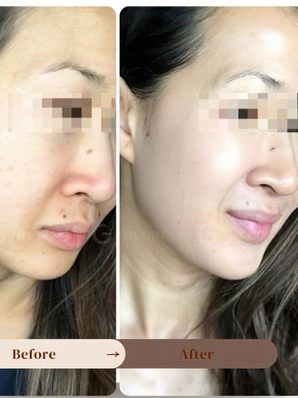 Liệu pháp peel da an toàn được chuyên gia tin tưởng, thay thế filler và botox