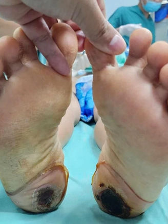 Chữa đau cột sống bằng 'kinh nghiệm dân gian', bệnh nhân suýt liệt vĩnh viễn