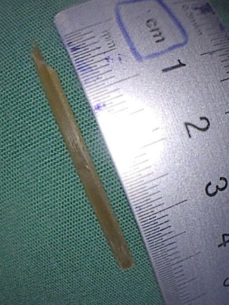 Gắp nhánh sả dài 3,5 cm ra khỏi dạ dày người phụ nữ