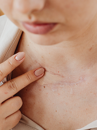 Những vết sẹo như là 'lời nhắc nhở' hằng ngày mà ta không muốn nói