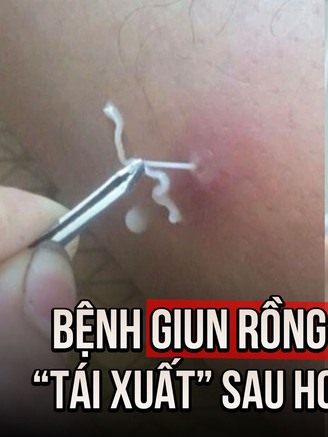 Bệnh giun rồng hiếm gặp 'tái xuất' tại Việt Nam sau hơn 20 năm: Cách để lấy giun khỏi cơ thể an toàn
