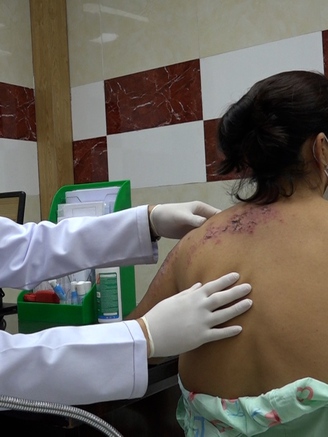 Zona thần kinh: nỗi ám ảnh của người mắc bệnh nền