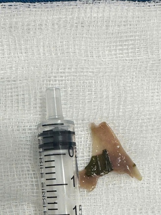 Quảng Ngãi: Nội soi gắp xương vịt sắc nhọn ở thực quản, cứu bé trai 12 tuổi
