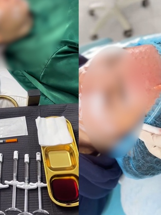 Thẩm mỹ 'chui' bủa vây: Cận cảnh quy trình làm đẹp không phép tại Đà Nẵng