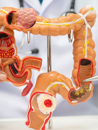 Cảnh báo mức độ trẻ hóa của ung thư đại trực tràng
