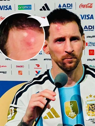 Messi sưng vêu trán sau trận thắng Cabo Verde: Vì sao nên nỗi?