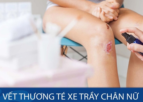 Bị té xe pháo xước chân nên làm những gì nhằm chỗ bị thương nhanh khỏi và ngừa sẹo xấu?- Hình ảnh 1.