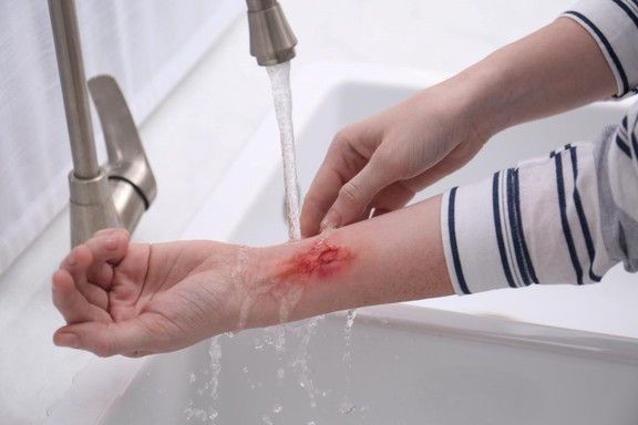 Hướng dẫn sử dụng chai xịt vết thương Hemacut Spray giúp mau lành và ngăn ngừa sẹo- Ảnh 7.