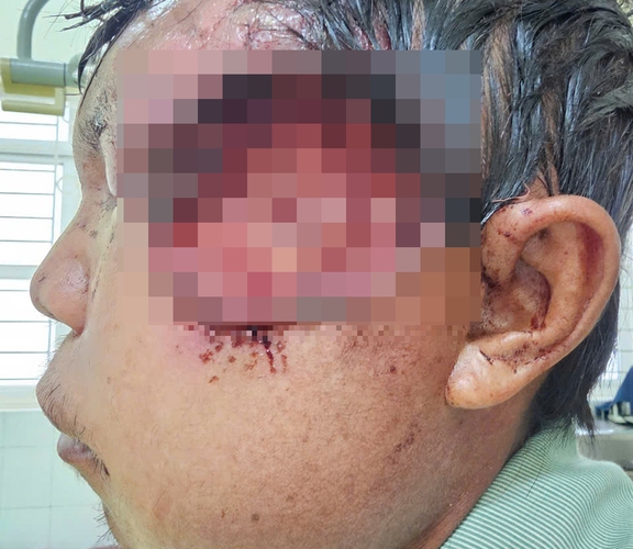 Đổ thuốc diệt cỏ làm sạch vết thương, nam bệnh nhân hoại tử mặt, có dòi - Ảnh 1.