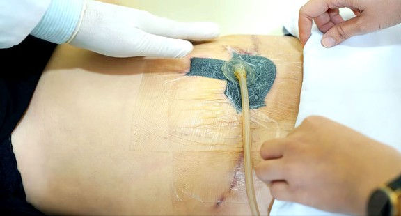 Làm sao để vết thương sau phẫu thuật kh…