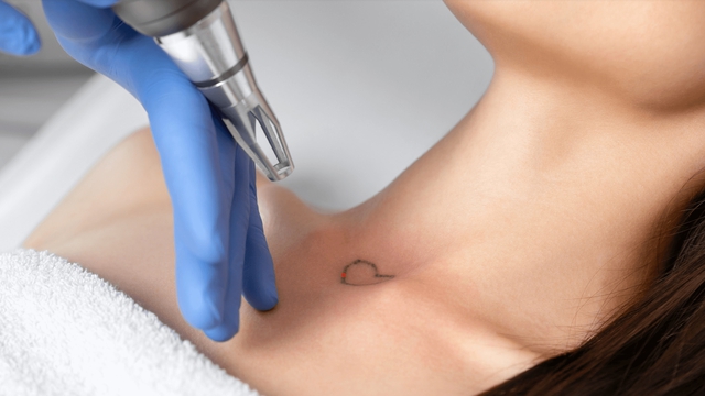 Xóa hình xăm bằng Laser có đau không? - Ảnh 3. Xóa hình xăm bằng Laser có đau không? - Ảnh 3.