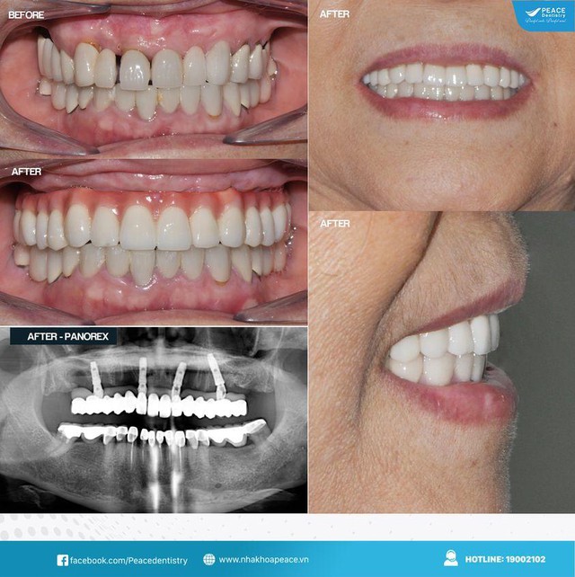Trồng răng Implant tại Nha khoa Peace Dentistry - phương pháp phục hình tối ưu - Ảnh 3.