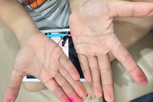 Vụ hàng nghìn dân tố bị khó thở, mẩn ngứa: CDC sẽ xét nghiệm mẫu nước 'sạch' - Ảnh 2. Vụ hàng nghìn dân tố bị khó thở, mẩn ngứa: CDC sẽ xét nghiệm mẫu nước 'sạch' - Ảnh 2.