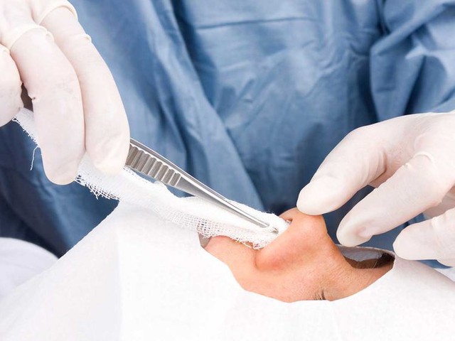 Mũi bị xơ cứng, vẹo lệch sau khi phẫu thuật nâng mũi cấu trúc, vì sao? - Ảnh 5. Mũi bị xơ cứng, vẹo lệch sau khi phẫu thuật nâng mũi cấu trúc, vì sao? - Ảnh 5.