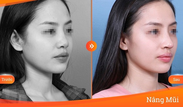 Mũi bị xơ cứng, vẹo lệch sau khi phẫu thuật nâng mũi cấu trúc, vì sao? - Ảnh 3. Mũi bị xơ cứng, vẹo lệch sau khi phẫu thuật nâng mũi cấu trúc, vì sao? - Ảnh 3.