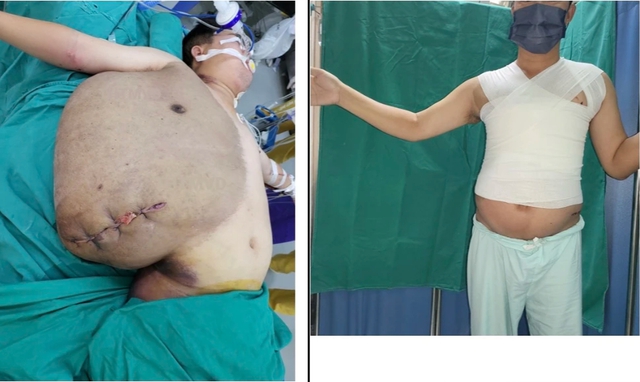 Phẫu thuật cắt khối u khổng lồ hơn 30 năm 'ăn' lưng bệnh nhân - Ảnh 1.