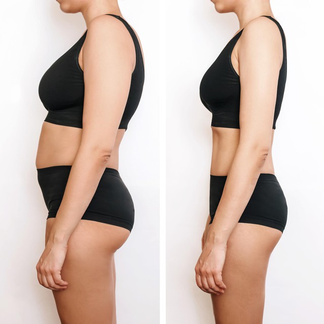 Trước và sau khi thực hiện hút mỡ Trước và sau khi thực hiện hút mỡ