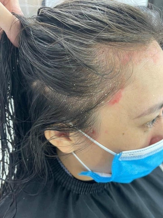 Nấm da đầu là nguyên nhân chính gây nên gàu mảng Nấm da đầu là nguyên nhân chính gây nên gàu mảng