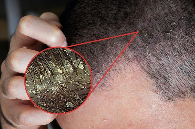 Gãi đầu thường xuyên khiến da đầu bọng tróc mảng gàu nhiều hơn