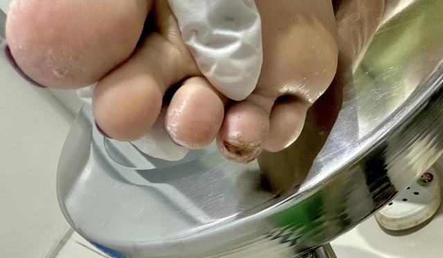 Bác sĩ cảnh báo nhiễm nấm da trong mùa mưa - Ảnh 1. Bác sĩ cảnh báo nhiễm nấm da trong mùa mưa - Ảnh 1.