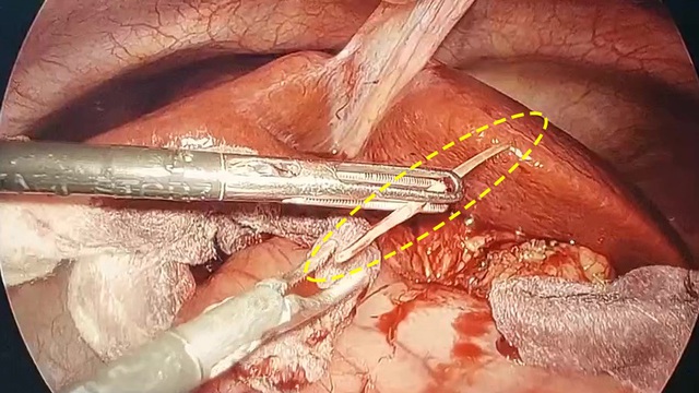Sau 1 tháng ăn cá, nam thanh niên được phát hiện áp xe tụy do xương cá - Ảnh 1. Sau 1 tháng ăn cá, nam thanh niên được phát hiện áp xe tụy do xương cá - Ảnh 1.