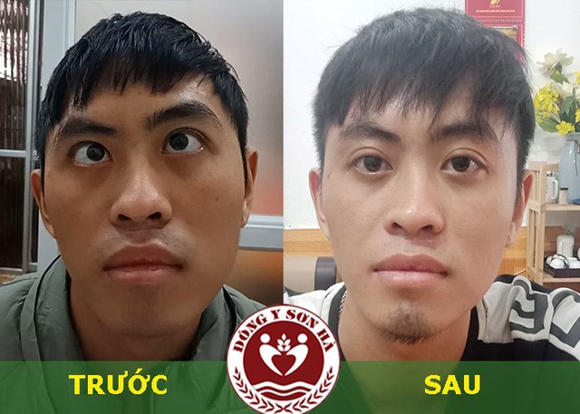 Bệnh mắt lác (lé): Điều trị bằng đông y, giải pháp an toàn, hiệu quả - Ảnh 1. Bệnh mắt lác (lé): Điều trị bằng đông y,ệnhmắtlácléĐiềutrịbằngđôngygiảiphápantoànhiệuquả<strong>b29. bet</strong> giải pháp an toàn, hiệu quả - Ảnh 1.