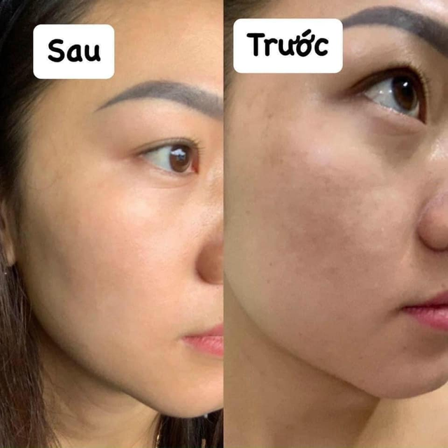 Review serum VI Derm Retinoic có tác dụng ngừa mụn, chống lão hóa không? - Ảnh 5.