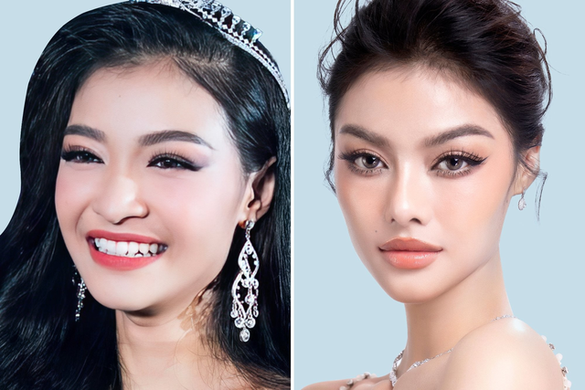 Nâng mũi sụn surgiform: Có nên hay không? - Ảnh 2. photo-1698749511756