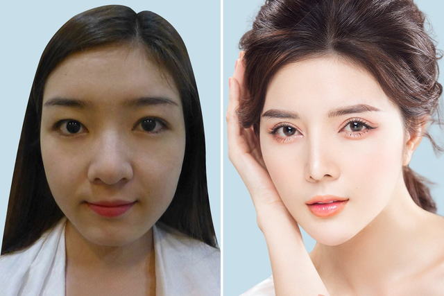 Nâng mũi sụn surgiform: Có nên hay không? - Ảnh 3. photo-1698749512338