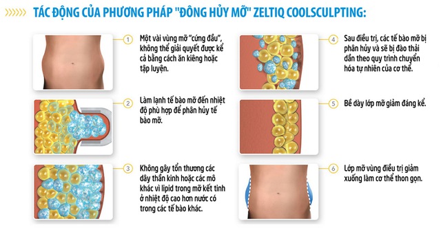 Thon gọn cơ thể bằng phương pháp "đông hủy mỡ" với Coolsculpting - Ảnh 2. Thon gọn cơ thể bằng phương pháp "đông hủy mỡ" với Coolsculpting - Ảnh 2.