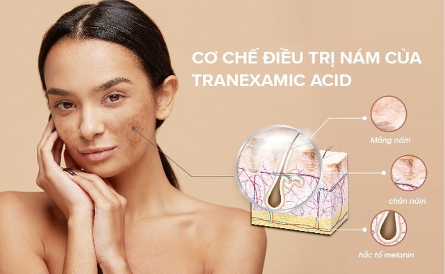 Top 7 sản phẩm chứa Tranexamic Acid trị nám không gây bong tróc, mẩn đỏ - Ảnh 2.