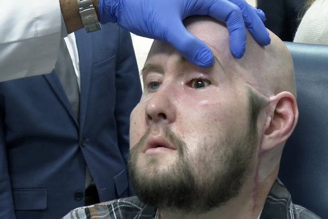 Bác sĩ Mỹ thực hiện ca cấy ghép toàn bộ mắt đầu tiên trên thế giới - Ảnh 2.