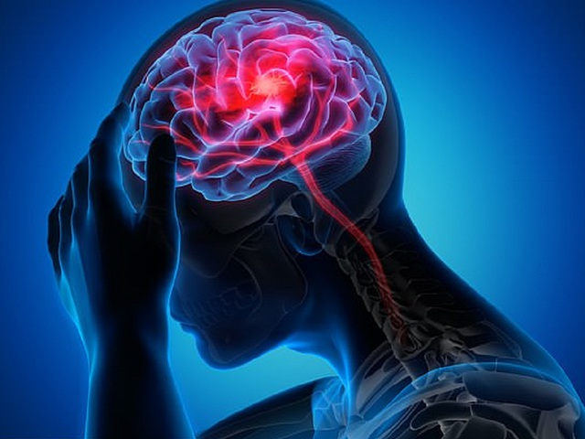 Chuyện lạ: bị hơn 100 cơn đột quỵ nhỏ trong 1 tuần, bệnh nhân vẫn sống - Ảnh 1. Chuyện lạ: bị hơn 100 cơn đột quỵ nhỏ trong 1 tuần, bệnh nhân vẫn sống - Ảnh 1.