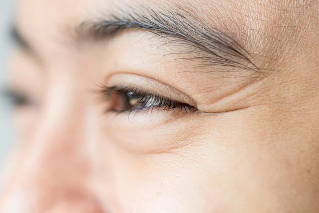 Những vết chân chim ở mắt và điều cần biết khi xóa nếp nhăn bằng Botox - Ảnh 1. Những vết chân chim ở mắt và điều cần biết khi xóa nếp nhăn bằng Botox - Ảnh 1.